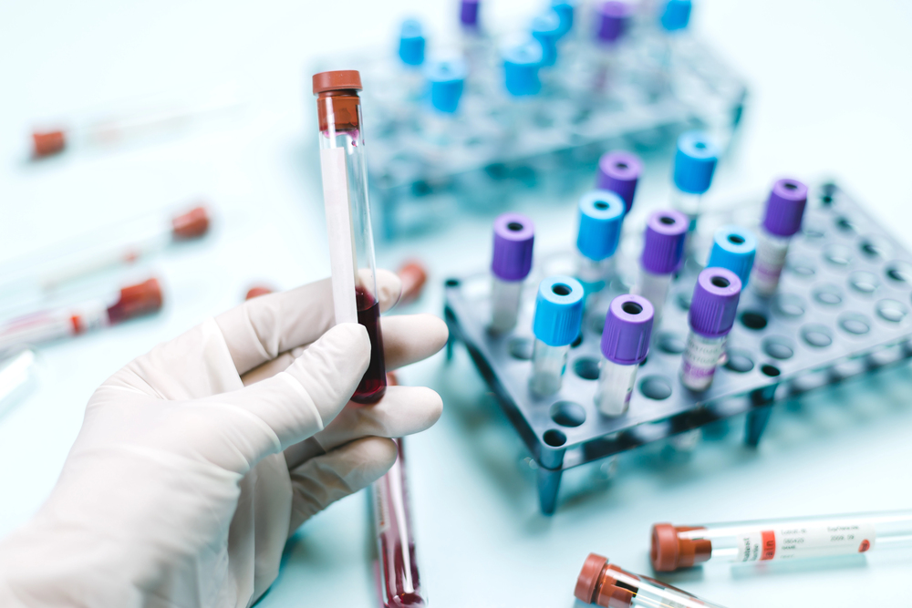 Revoluce u rakoviny slinivky: Češi mají krevní test s 90% přesností